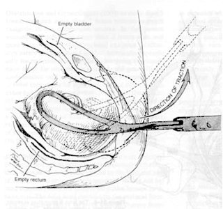 Fig 1 Fødsel